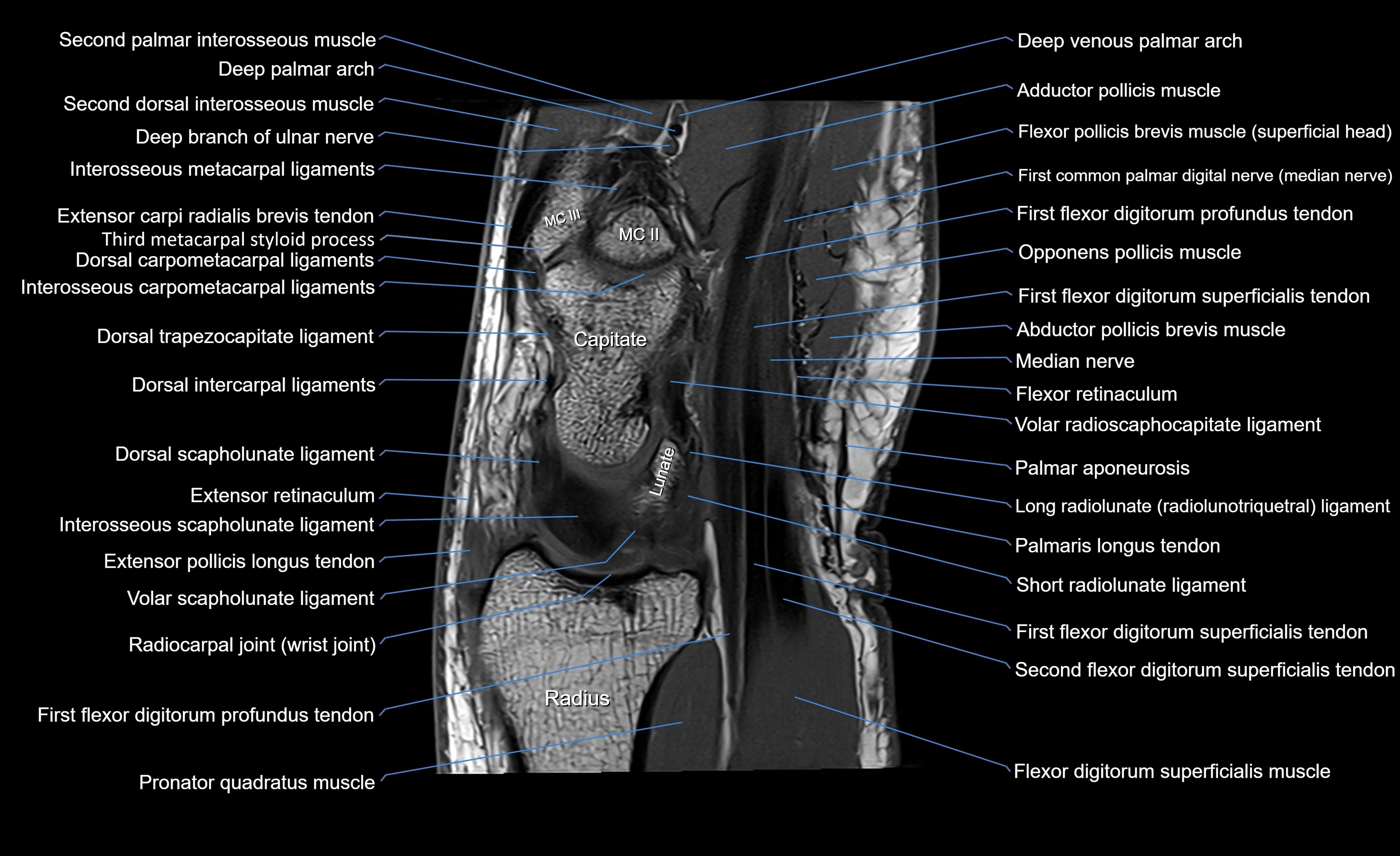 MRI wrist sagittal cross sectional anatomy 3T  radiology  image-img-00001-00011.webp